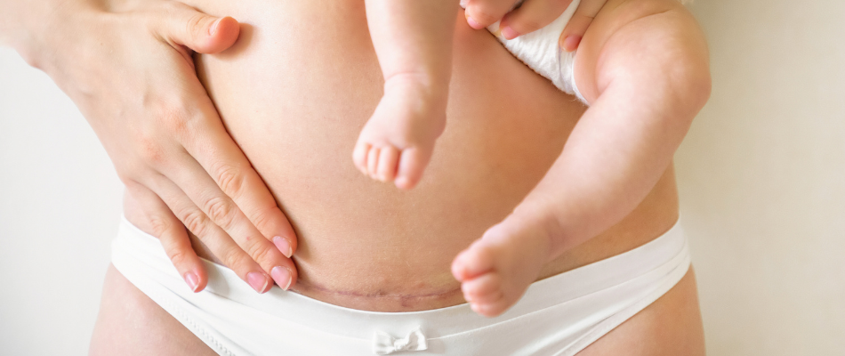 Eine Frau mit Kaiserschnittnarbe am Bauch hält ein Baby in den Armen. Beide tragen weiße Unterwäsche.