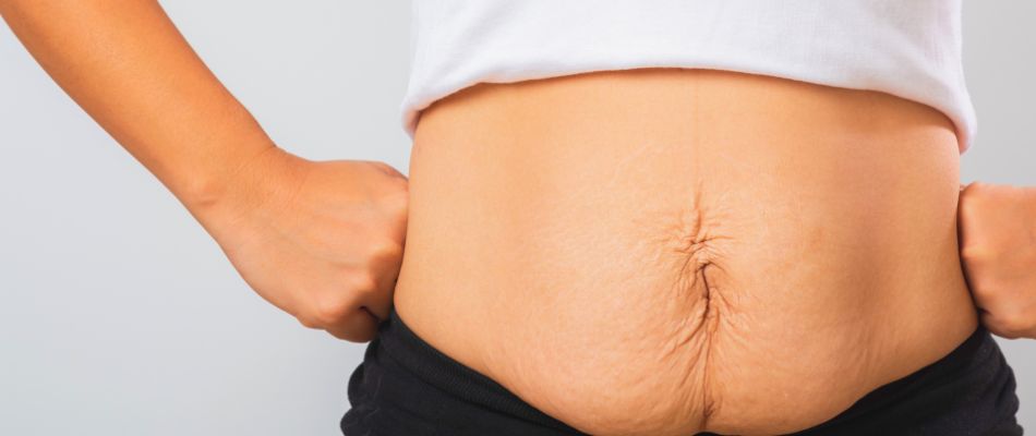 Ein Bauch nach der Schwangerschaft zeigt gedehnte Haut mit sichtbaren Dehnungsstreifen. Die Person trägt ein weißes Oberteil und schwarze Hosen, die sie mit beiden Händen hält.