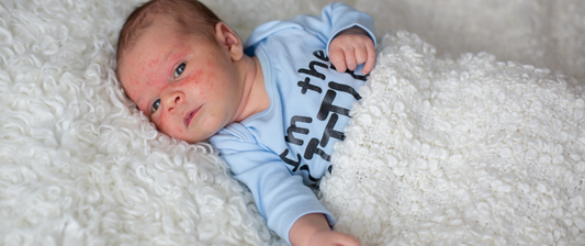 Ein Baby mit roten Pusteln im Gesicht liegt in blauer Kleidung auf einer weichen, weißen Decke und schaut in die Kamera.
