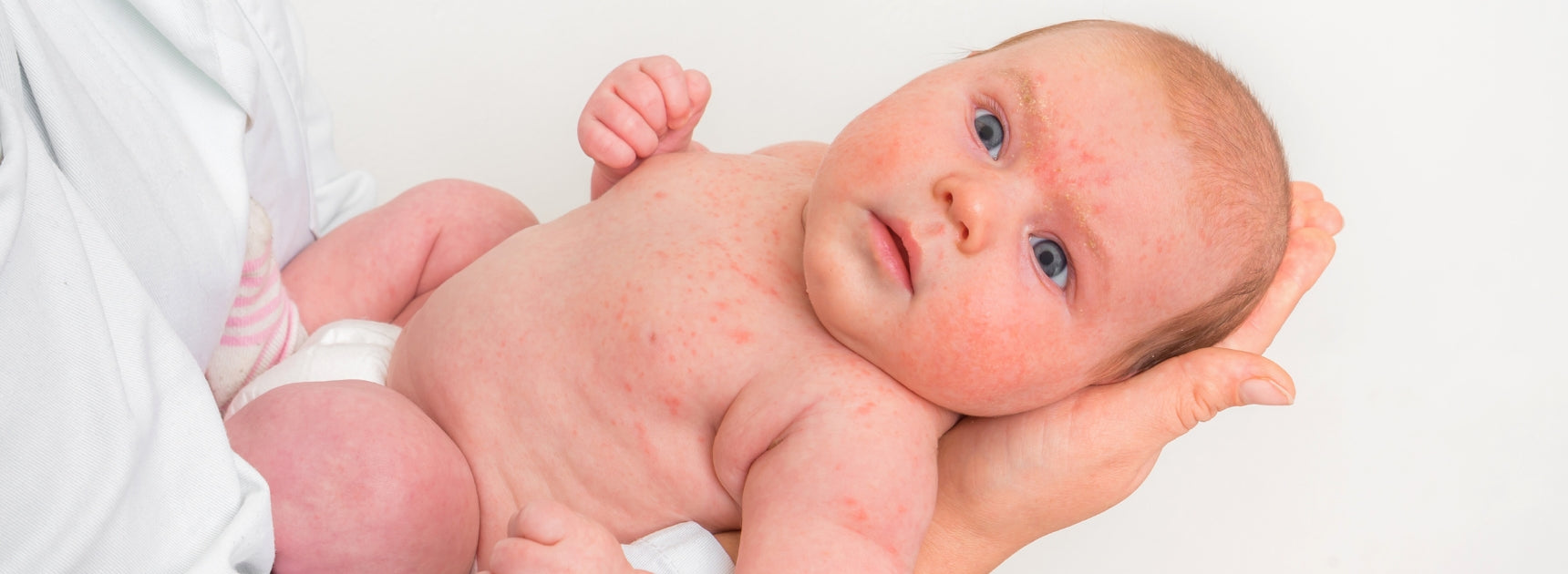 Baby hat Ausschlag
